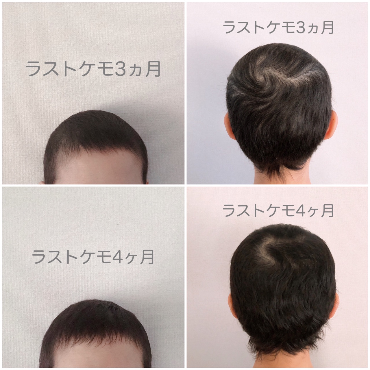 ラストケモ5か月 果たして脱ウィッグなるか Jamのおうち ごはんと器とインテリア Powered By ライブドアブログ