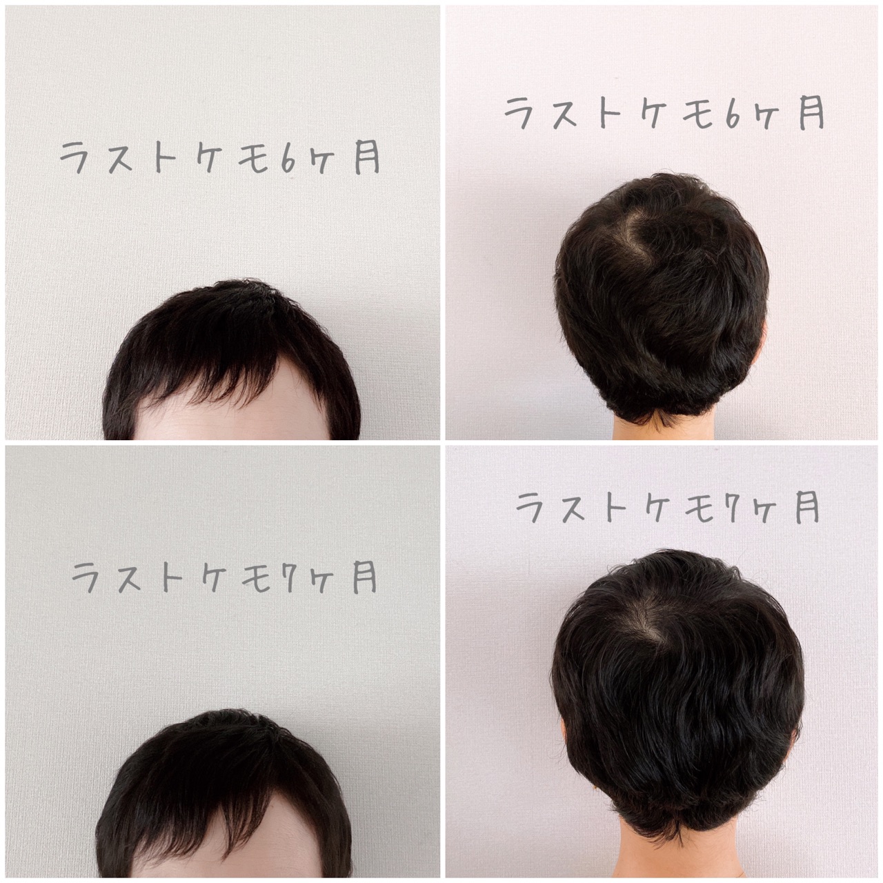 ラストケモ10ヶ月 髪の毛事情 Jamのおうち ごはんと器とインテリア Powered By ライブドアブログ