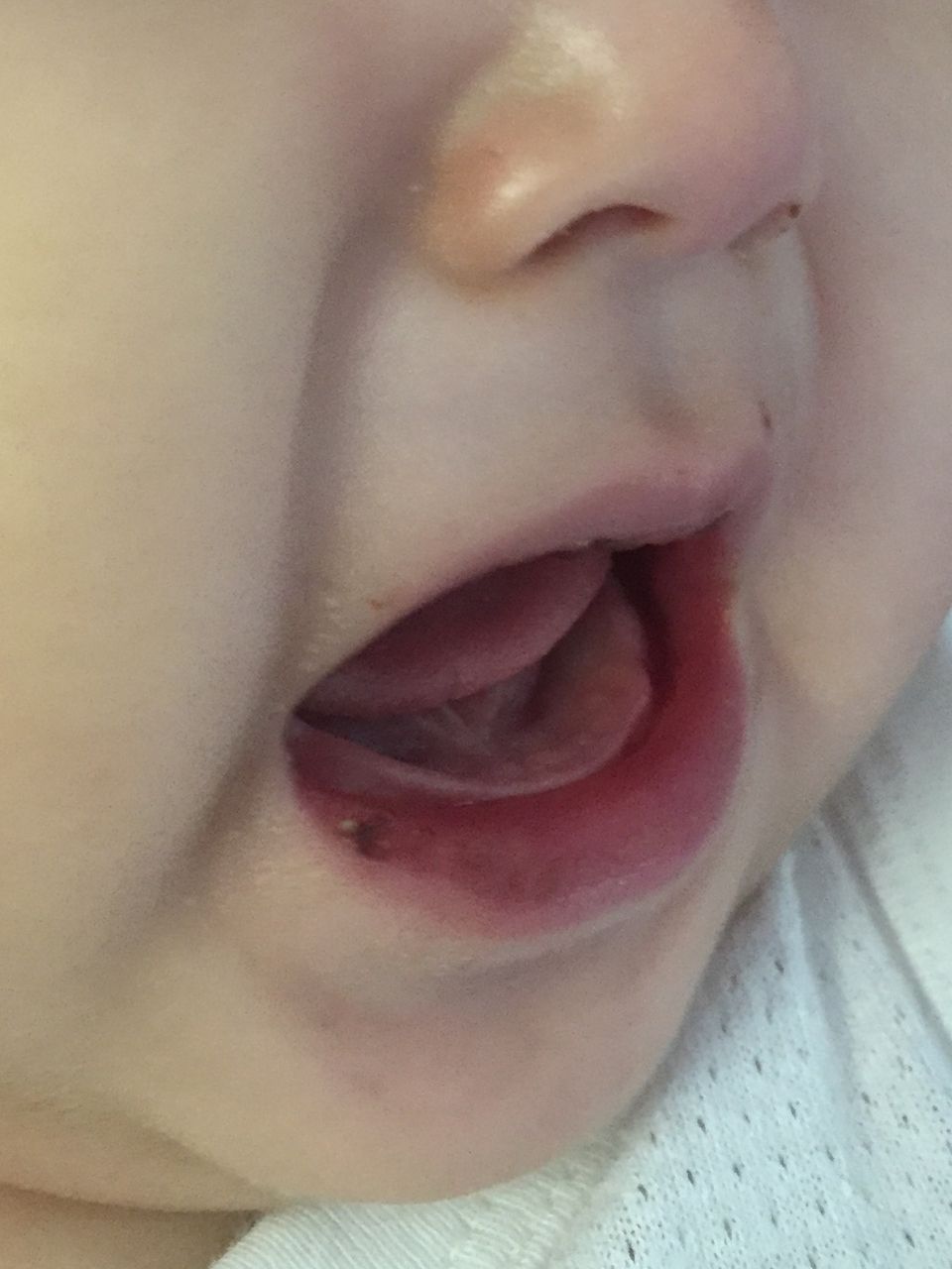 川崎病 15病日 入院13日目 唇がピンク色 しょぼりんはうす建築記