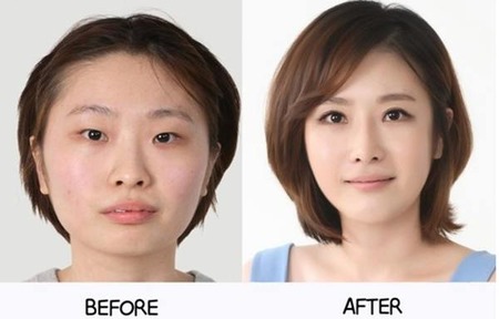 plastic-surgery-in-korea-6