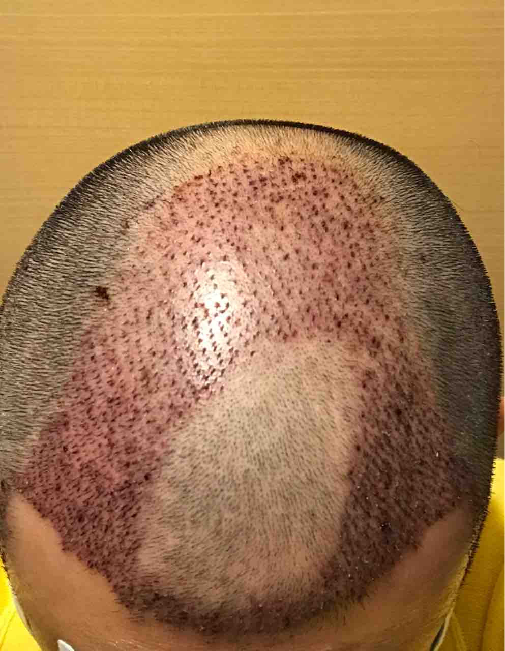 手術後2日目 韓国植毛でフサフサになりたいブログ Moten医院