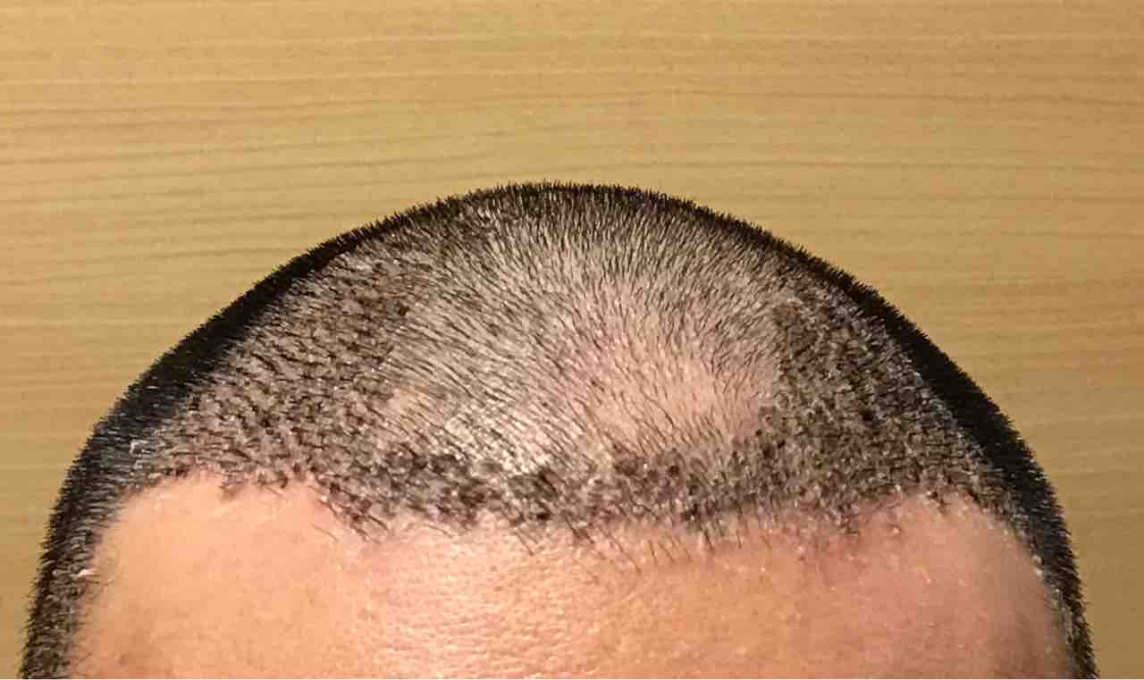 手術後7日目 韓国植毛でフサフサになりたいブログ Moten医院