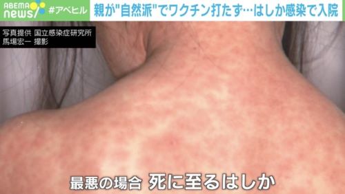 はしか　麻疹　ワクチン　自然派　母親　免疫に関連した画像-01