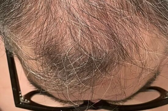 お笑い芸人　兵動大樹　矢野・兵動　薄毛　発毛剤　発毛薬　モニター　ハゲ　ふさふさ　毛に関連した画像-01