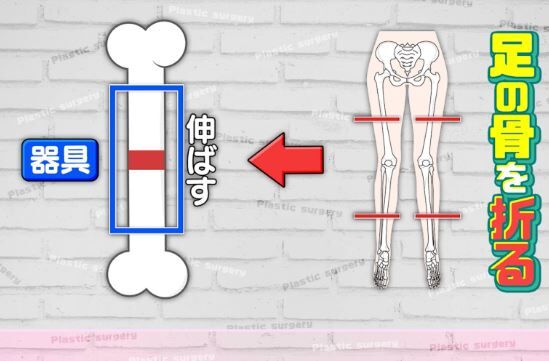 YouTuber 骨延長 身長 コンプレックス イワサキに関連した画像-01