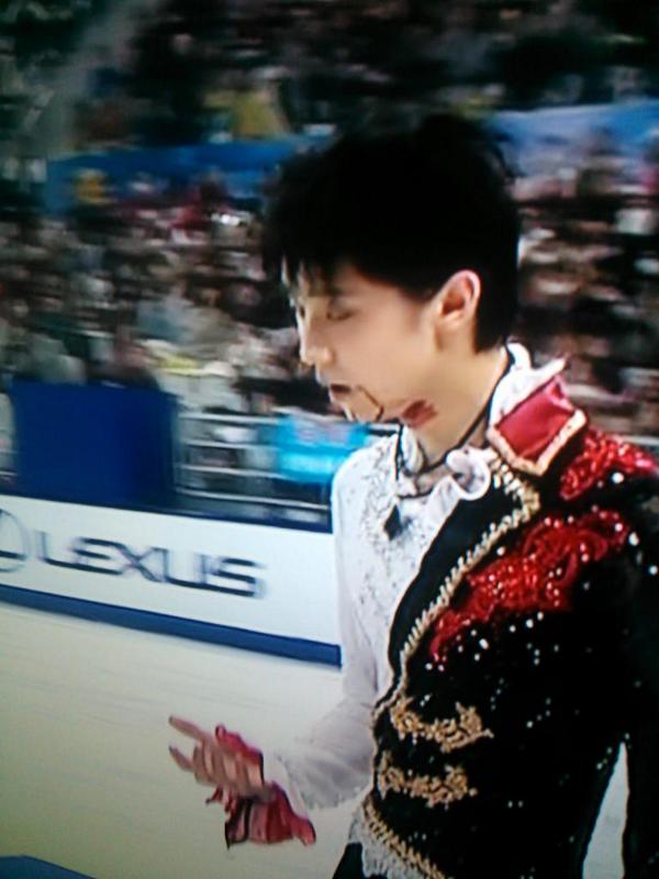 羽生結弦 事故 流血に関連した画像-05