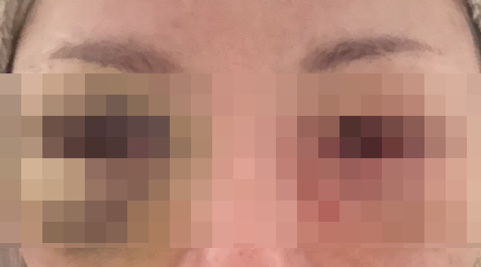 女性 整形 クマ取り 失敗 失明 片目 全盲に関連した画像-01