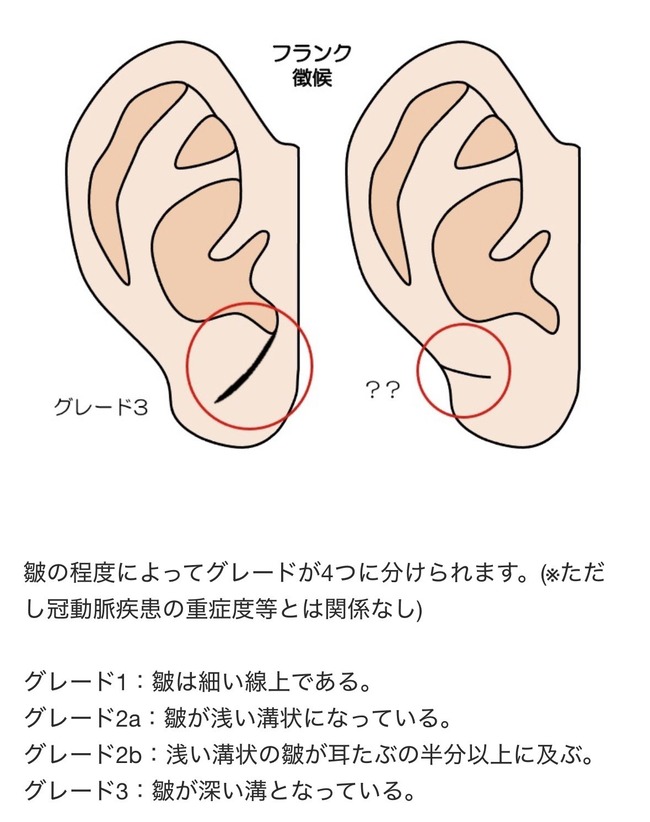 堀大輔 耳たぶ フランクサイン 冠動脈疾患 動脈硬化 スパチャ ブロックに関連した画像-06
