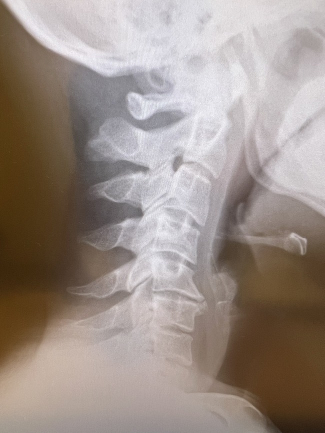 加藤純一 首 ヘルニア 病気 レントゲンに関連した画像-02