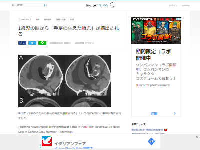 中国 胎児 赤ちゃん 脳 医学 手術 双子 寄生性双生児に関連した画像-02