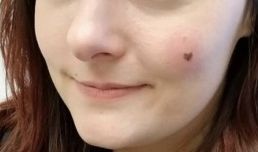 ほくろ　皮膚がん　メラノーマ　ハートに関連した画像-01