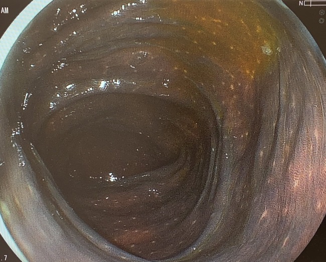 ダイエット 防風通聖散 漢方薬 便秘薬 副作用 黒皮症 大腸 蠕動 低下 神経叢 悪影響 便秘腸に関連した画像-02