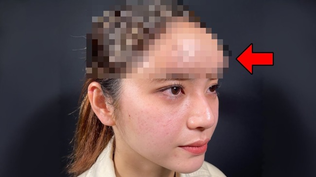 女性ユーチューバーさん 自分のおでこが気に入らず整形へ ヤバイことになってしまう 女性ユーチューバーさん 自分のおでこが気に入らず整形へ ヤバイことになってしまう