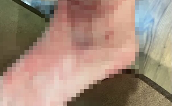 フリマ アプリ 中古 スニーカー 格安 アレルギー 女性 足 疥癬に関連した画像-01