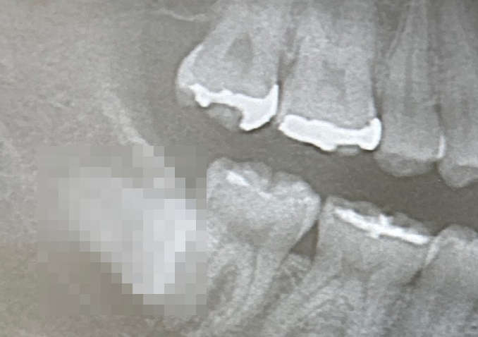 詰め物　歯医者　爆弾　親知らず　埋伏歯に関連した画像-01