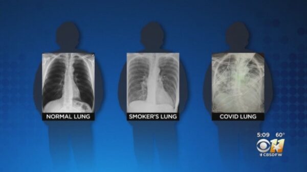 新型コロナウイルス　感染者　肺　レントゲン　画像　喫煙者　比較に関連した画像-04