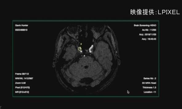 AI ディープラーニング 脳 病気 医療機器に関連した画像-01