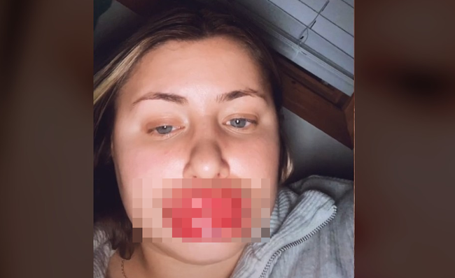 アメリカ 女性 唇 ヒアルロン酸 アレルギー反応 たらこ唇に関連した画像-01