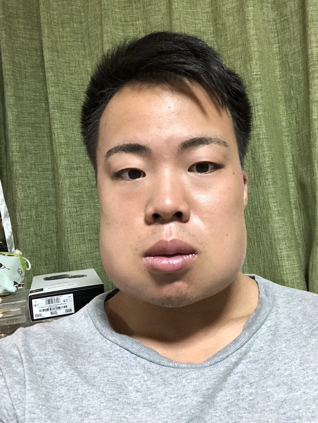 31万いいね 親知らずを4本抜いた男性の顔がヤバすぎる うわぁあああああああああ オレ的ゲーム速報 刃 31万いいね 親知らずを4本抜いた男性の顔がヤバすぎる うわぁあああああああああ オレ的ゲーム速報 刃