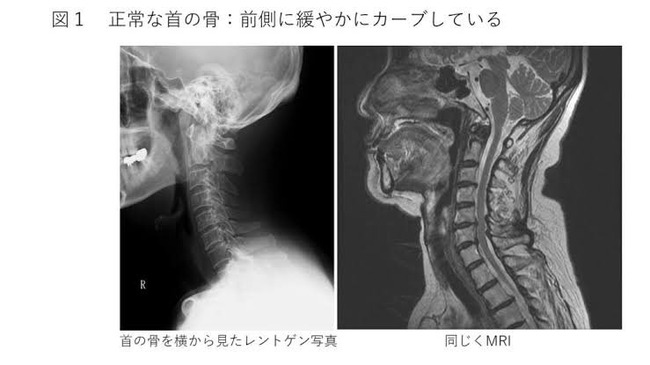 加藤純一 首 ヘルニア 病気 レントゲンに関連した画像-03