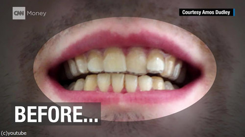 3Dプリンター 歯の矯正 自作に関連した画像-04