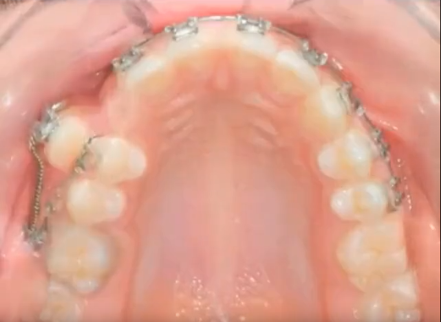 Before　After　歯　矯正　動画　タイムラプスに関連した画像-01