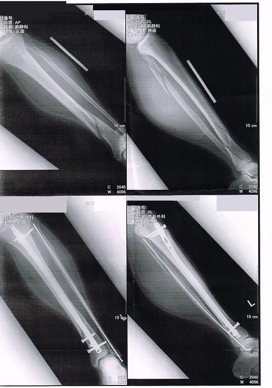 骨折日記 脛骨 腓骨 79 骨折から全快までの記録のまとめ 13 7 31 サロメ スタイル