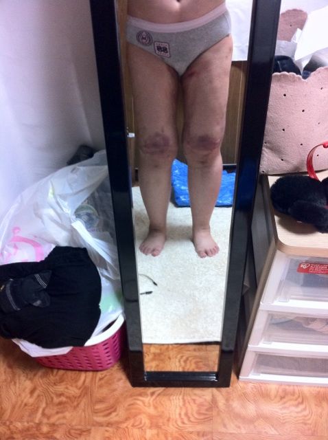 術後1日目 2日目 埋没ブログ 脂肪吸引ブログ