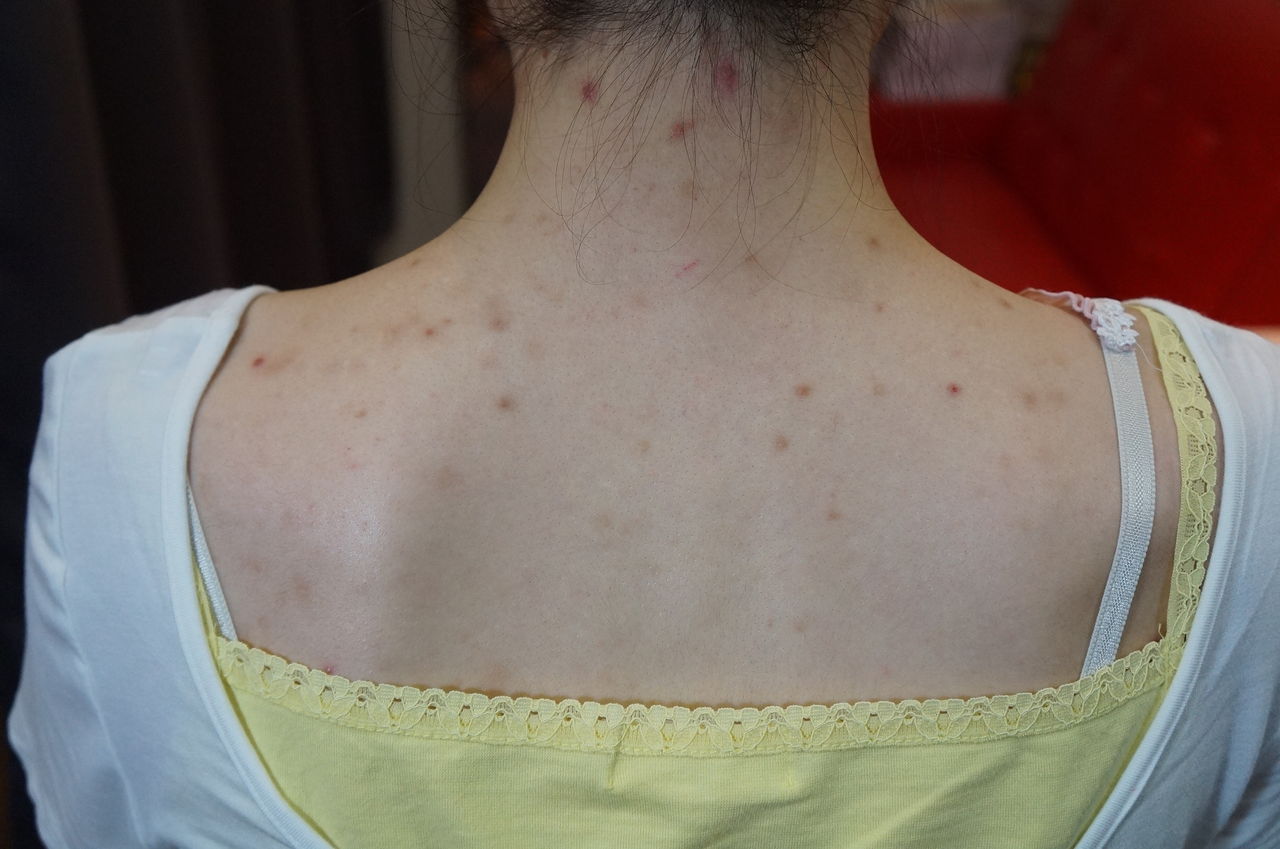 卒業式なのでニキビを特殊メイクで一時的に隠す Body Custom ジョシュアアント