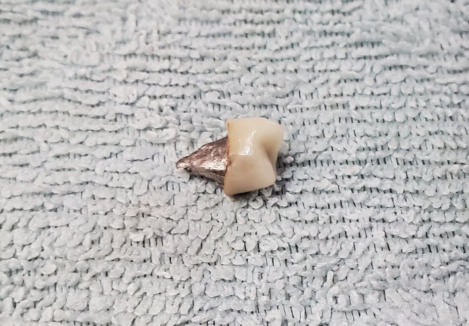 インプラント治療記録 差し歯取れた！