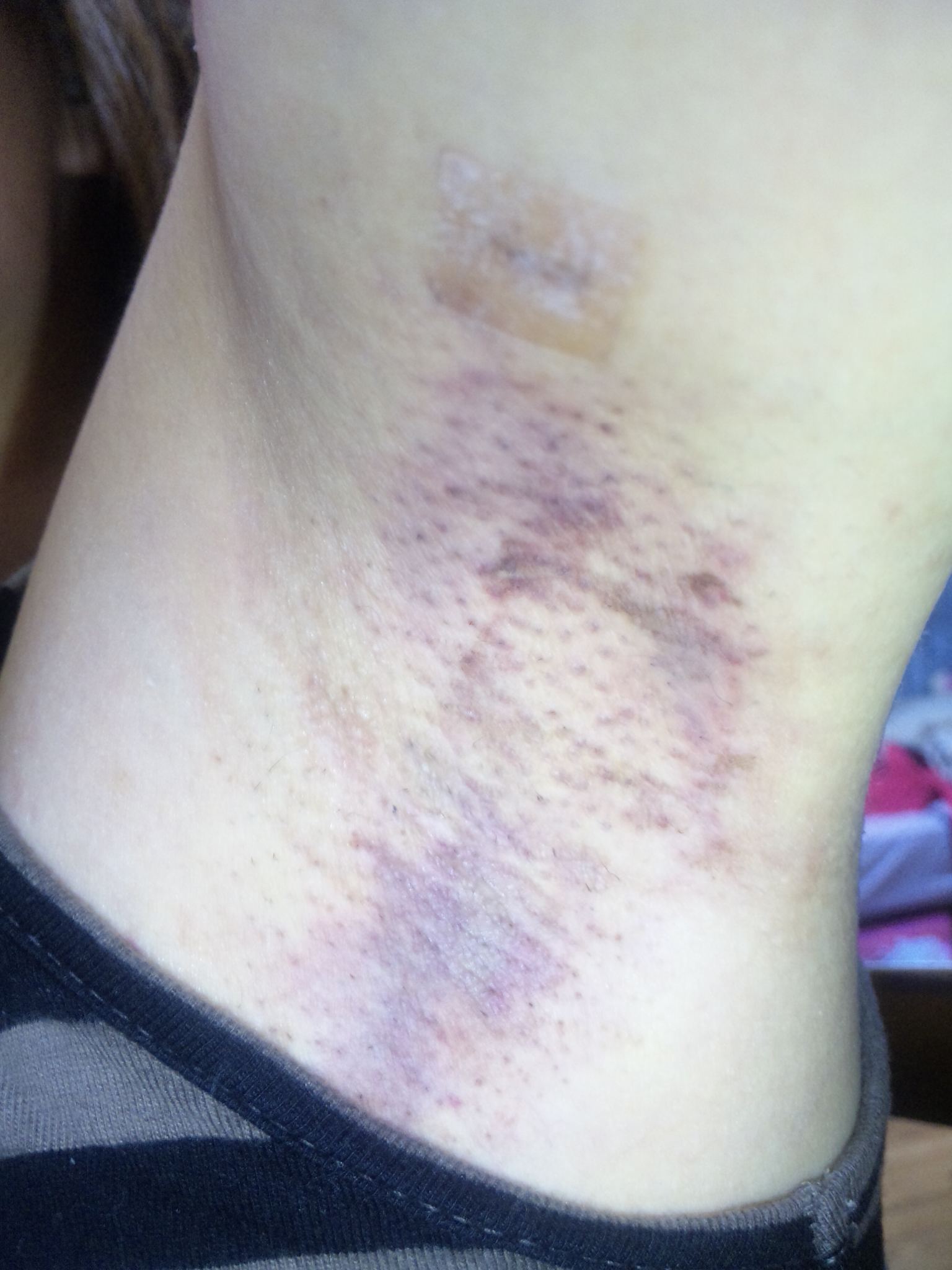 ワキガ手術の記録 09年09月