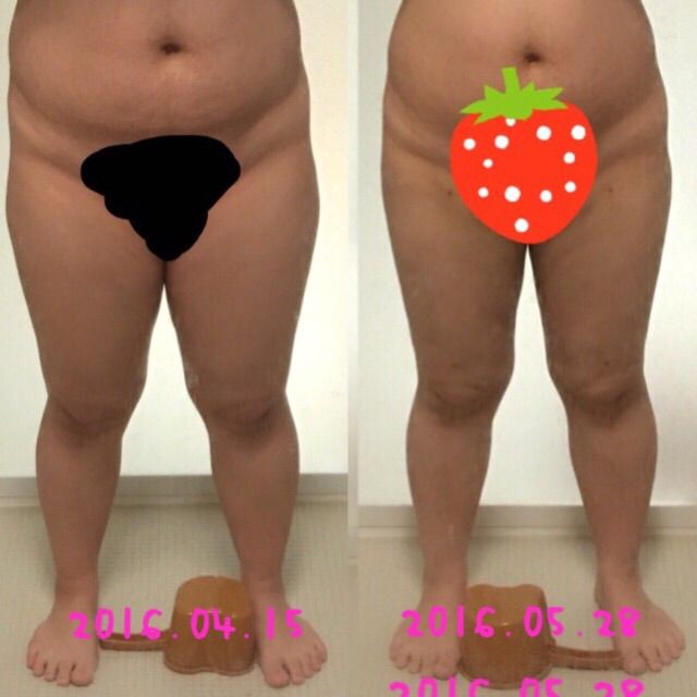 脂肪吸引 太もも 1ヶ月半経過 比較写真 ダイエット がｍばれ健康体