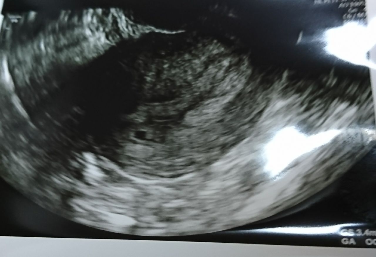 D34 Bt16 5w0d 胎嚢確認日 不安は尽きない アラフォー会社員の妊活記