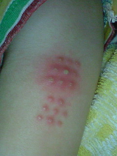 ｂｃｇ 接種後１ヵ月 いつもいっしょに