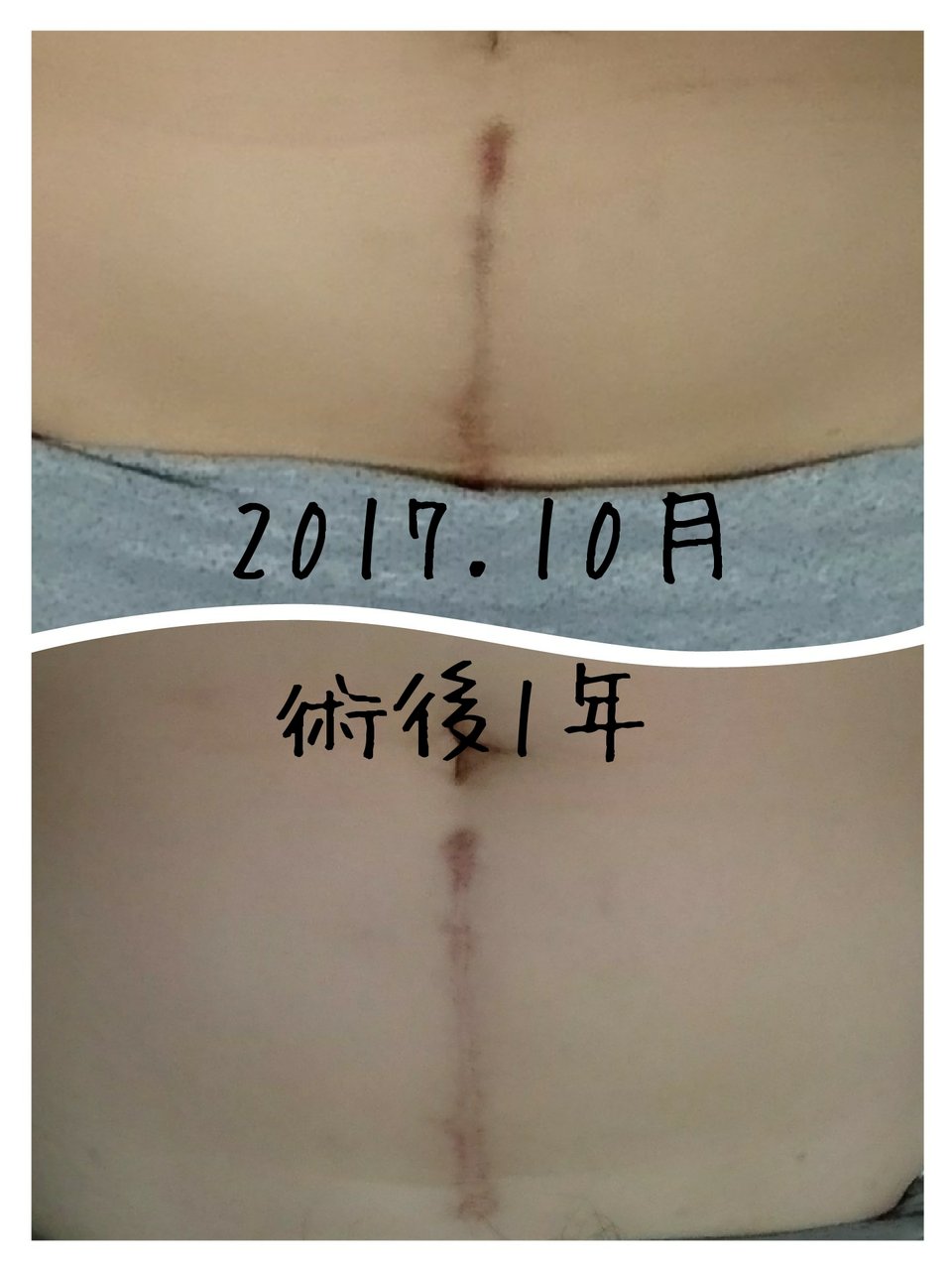 子宮筋腫で子宮全摘手術から一年経過しました 画像あり もぐタン子宮日記