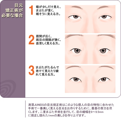 美容整形 １ 目 目元矯正術 清潭juneis