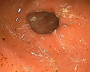 薬の付着した胃壁 ヘマチン