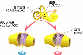 BPPV-2