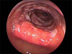 虚血性大腸炎