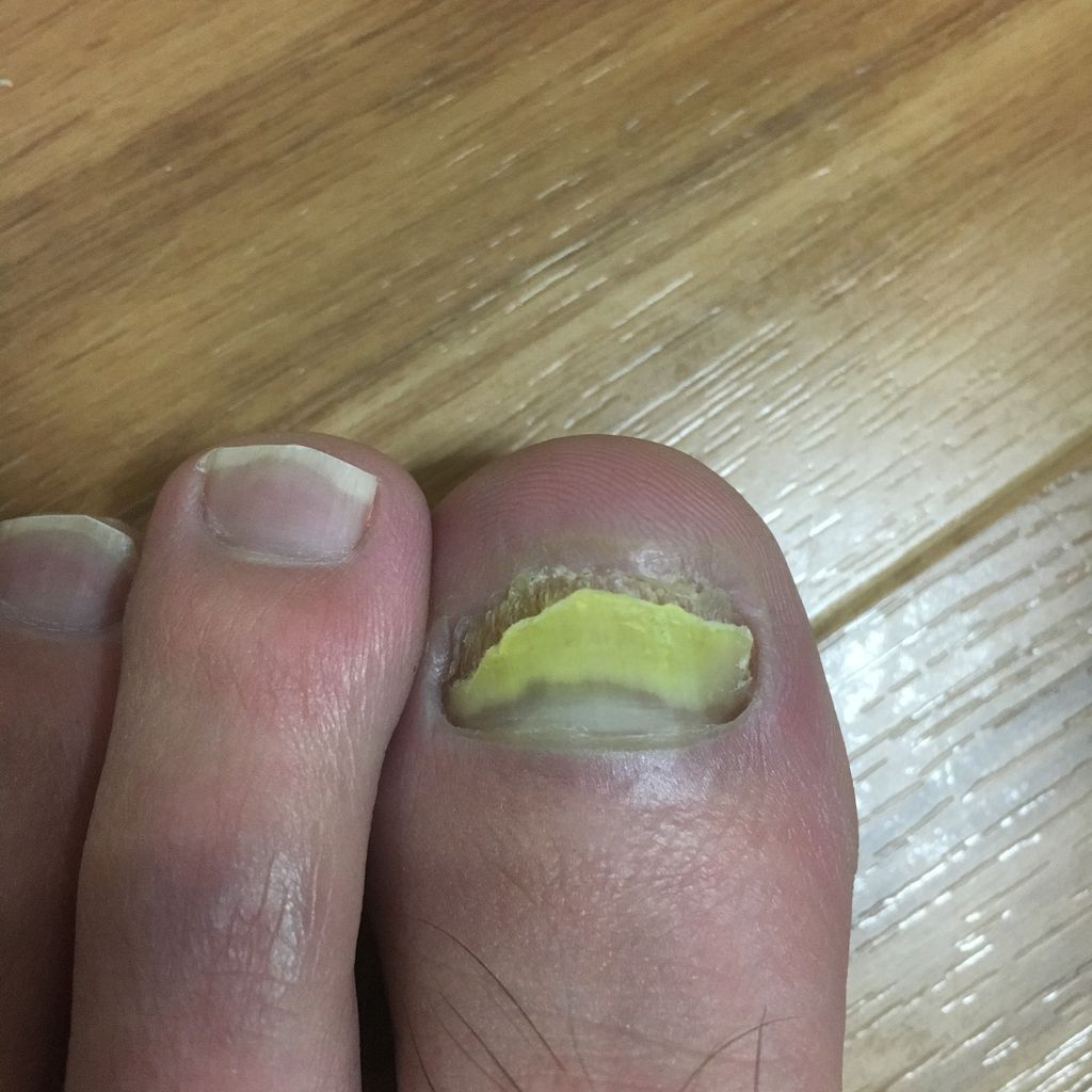 足の爪が白く濁って剥がれそうなので病院へ行ったら爪水虫 足の爪が白く濁って剥がれてきたから病院行ったら爪水虫 リアルな治療ブログ