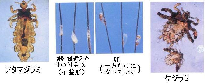 閲覧注意 毛ジラミが悪化するとこういうことになる まめログ 閲覧注意 毛ジラミが悪化するとこういうことになる まめログ