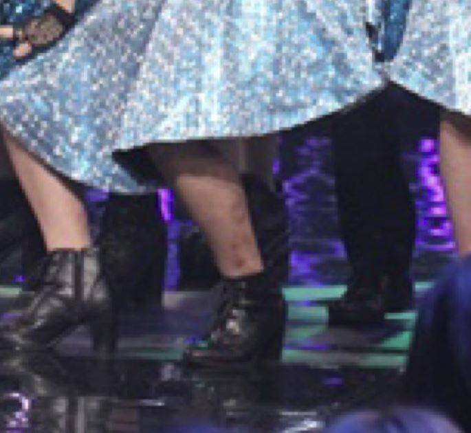 モー娘 エース小田さくら 謎の皮膚病が重症化 どんどん転移してる 元々ステロイドで隠してたが効かなくなり さらに強いのでも効かなくなったパターン Anti Today アンチトゥディ モー娘 エース小田さくら 謎の皮膚病が重症化 どんどん転移してる 元々ステロイドで隠してたが効かなくなり さらに強いのでも効かなくなったパターン Anti Today アンチトゥディ