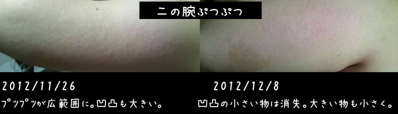 二の腕プツプツ