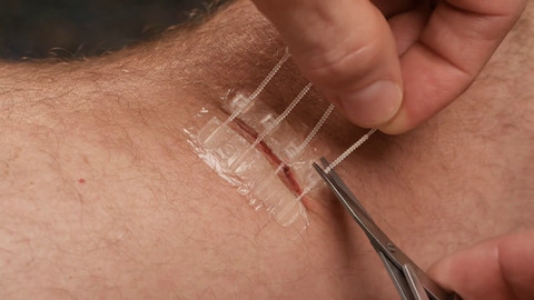 誰でも簡単に 縫合が必要な切り傷 に応急処置を施せる Zipstitch 科学系ちゃんねる 誰でも簡単に 縫合が必要な切り傷 に応急処置を施せる Zipstitch 科学系ちゃんねる