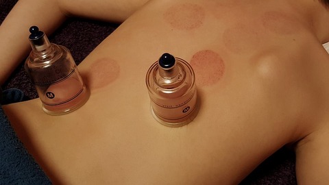 cupping-3310182_640