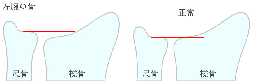 悲報 17 05 Tfcc損傷 Kagi Hike 悲報 17 05 Tfcc損傷 Kagi Hike