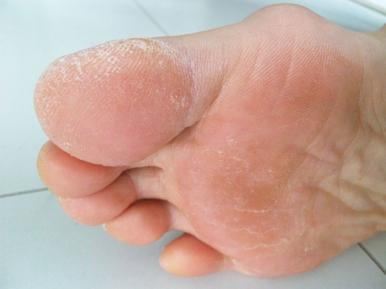 水虫をやっつけろ 私と水虫の戦い365日