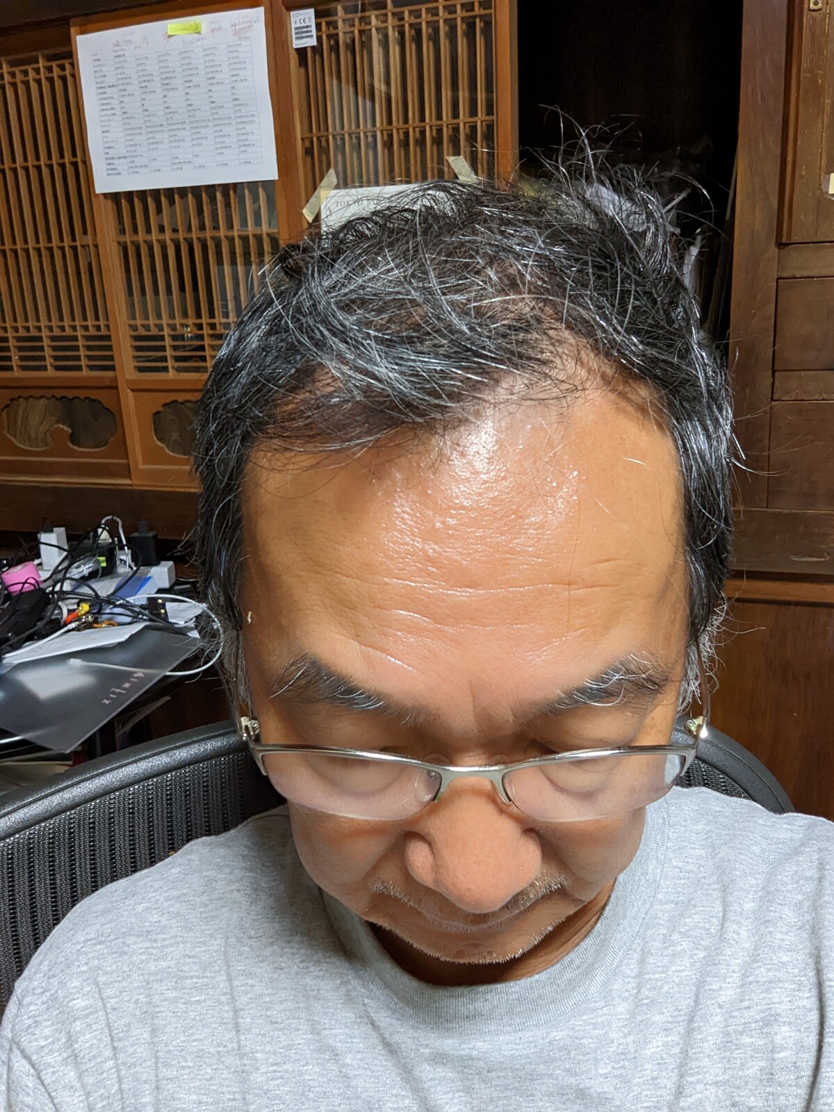 ハゲ対策を開始する 定年後 田舎作って コメ野菜