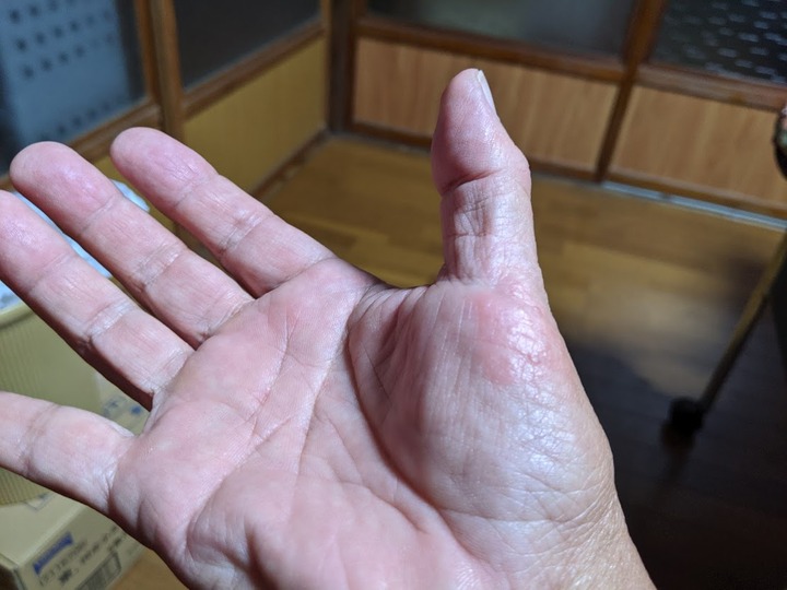 1024疱疹はわずか