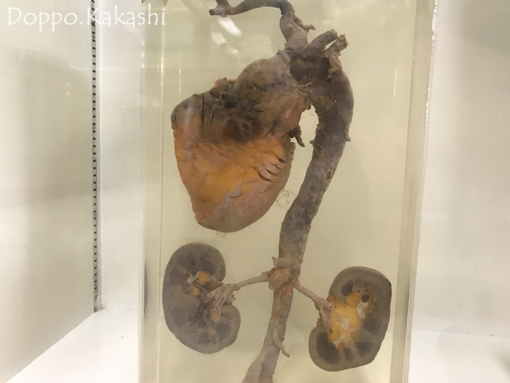 これは強烈 死体博物館 シリラート博物館 シリラート かかし バンコク独歩 バンコク半径2時間の旅 これは強烈 死体博物館 シリラート博物館 シリラート かかし バンコク独歩 バンコク半径2時間の旅